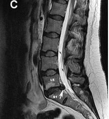 Herniated disk L5 S1: možné komplikace a způsoby léčby