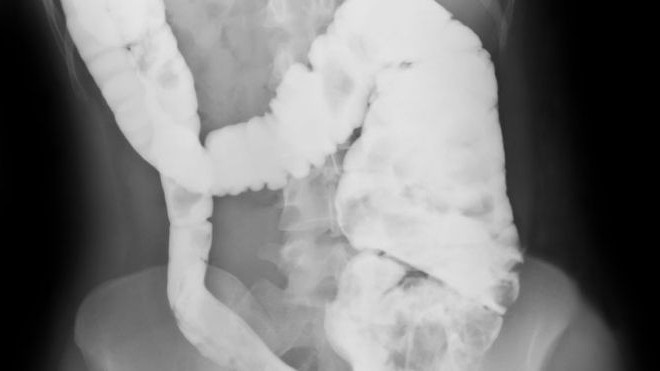 Jaké jsou příznaky Crohnovy nemoci? Jak je diagnostikována?