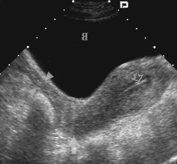 Tloušťka endometria: norma a hodnota