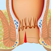 jak léčit anální pukliny